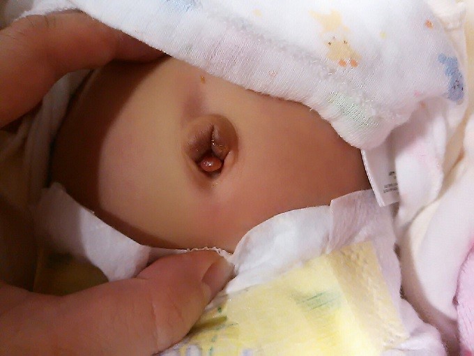 新生児の臍肉芽腫の写真